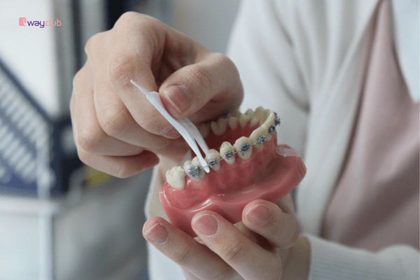 Cách rút ngắn thời gian niềng răng 