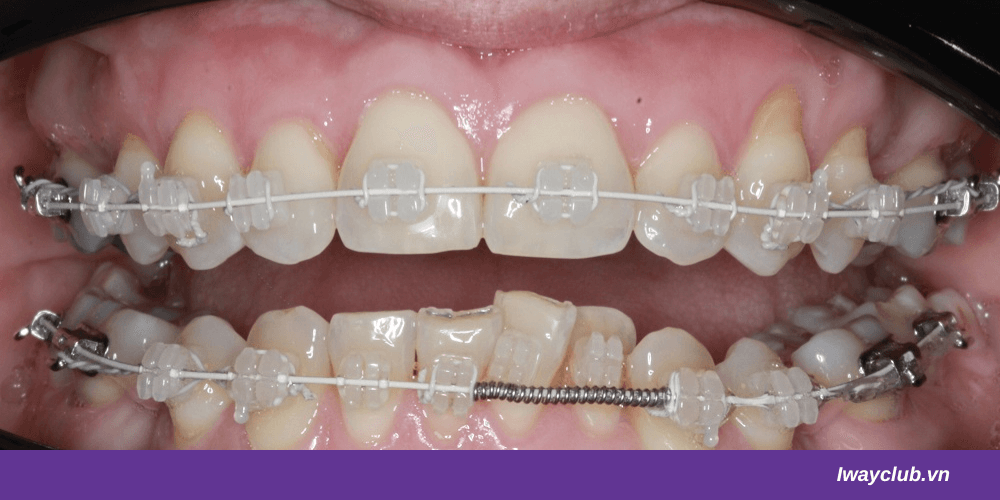 Niềng răng kết hợp là gì? Phân loại, quy trình và chi phí niềng kết hợp phẫu thuật 4 niềng răng kết hợp