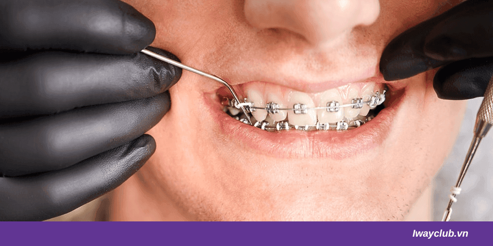 Niềng răng kết hợp là gì? Phân loại, quy trình và chi phí niềng kết hợp phẫu thuật 6 quy trình niềng răng kết hợp